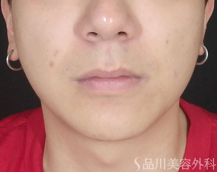症例NO.65061のBEFORE写真