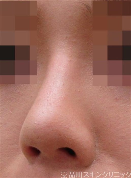 症例NO.32662のAFTER写真
