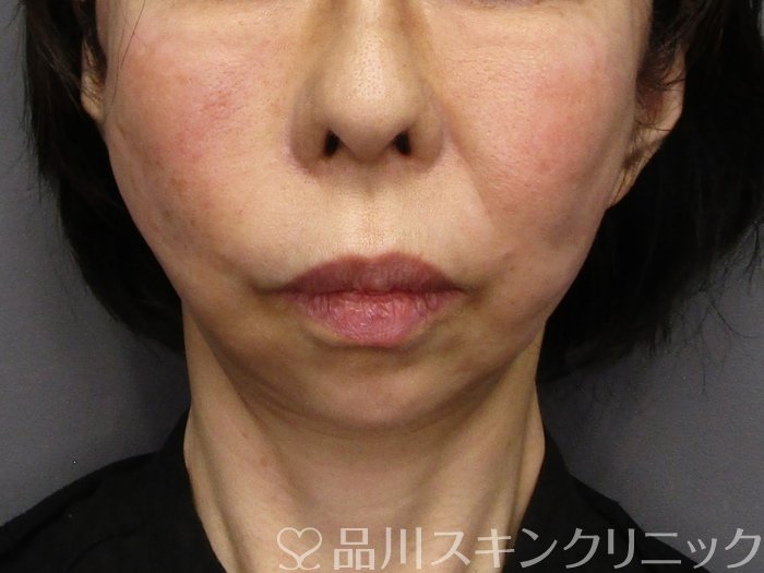 症例NO.75101のAFTER写真