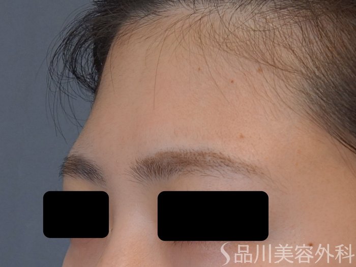 症例NO.74601のBEFORE写真