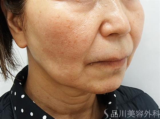 症例NO.47769のBEFORE写真