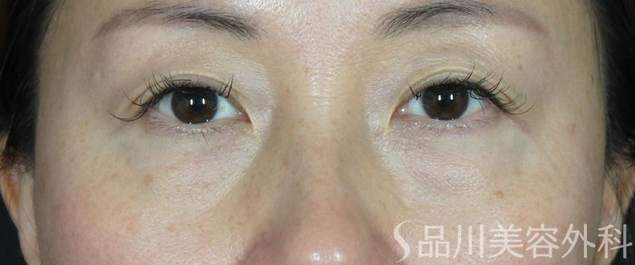 症例NO.63021のBEFORE写真