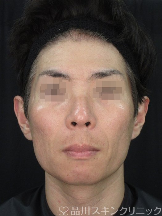 症例NO.72208のBEFORE写真