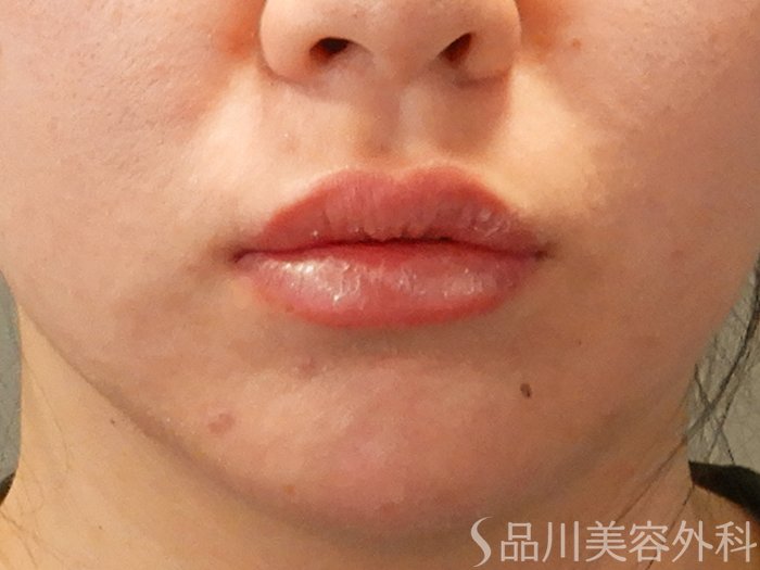 症例NO.70127のAFTER写真