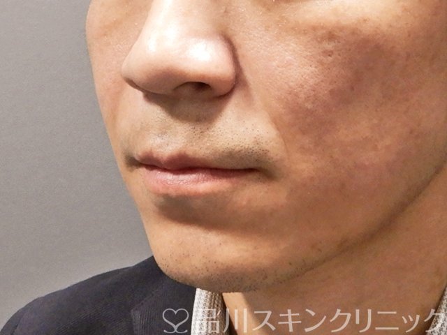 症例NO.68334のBEFORE写真