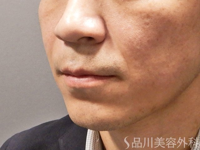 症例NO.68334のBEFORE写真