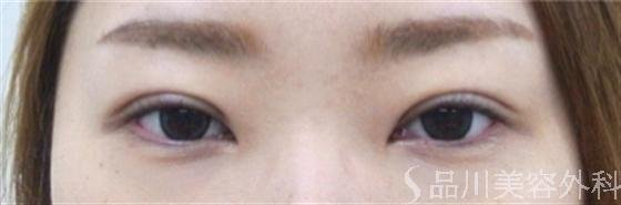 症例NO.11977のAFTER写真