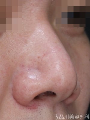 症例NO.74286のBEFORE写真