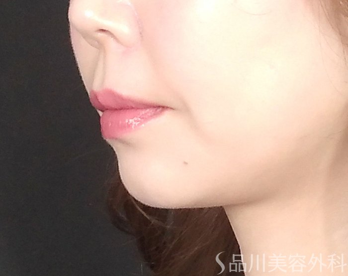 症例NO.69534のBEFORE写真