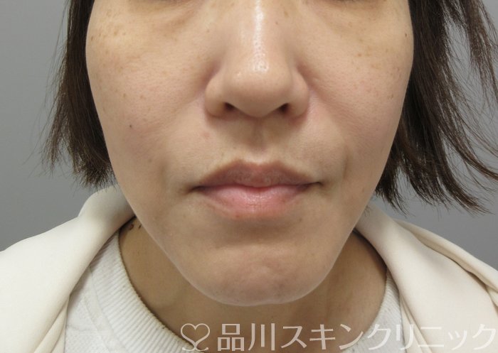 症例NO.69837のBEFORE写真