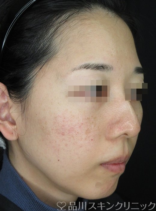 症例NO.71008のBEFORE写真