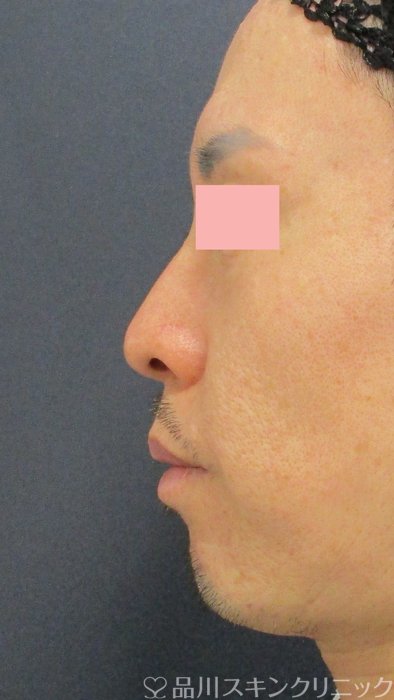 症例NO.71217のBEFORE写真