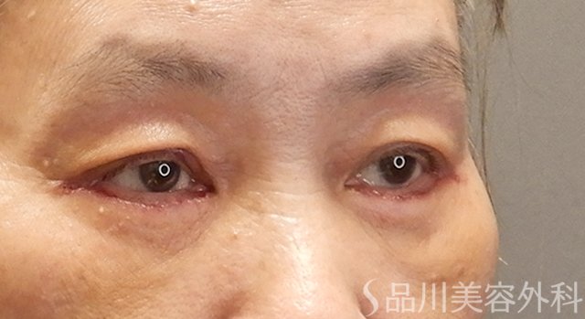 症例NO.73848のAFTER写真