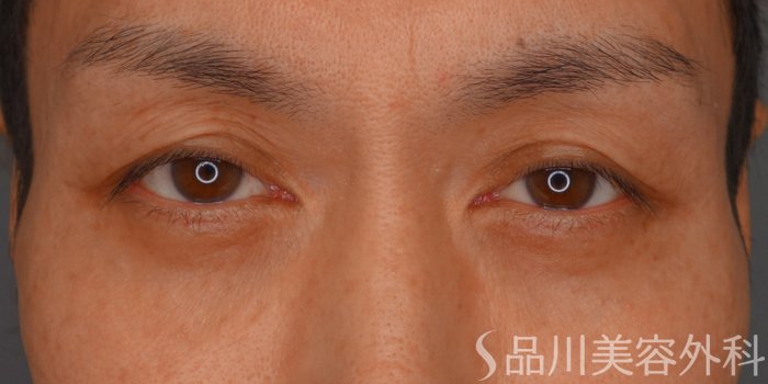 症例NO.74412のBEFORE写真