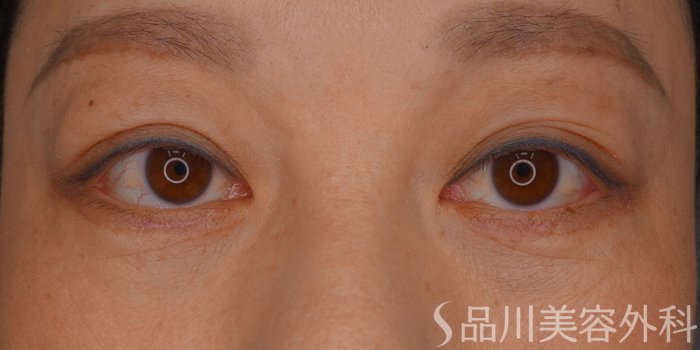 症例NO.73725のAFTER写真