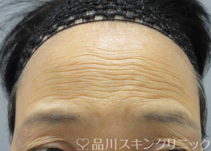 症例NO.72747のBEFORE写真