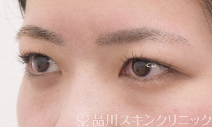 症例NO.71183のBEFORE写真