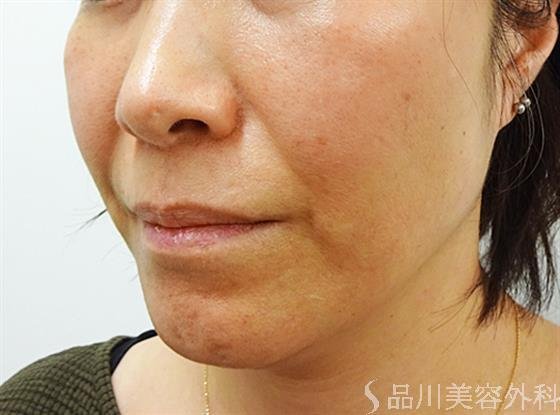 症例NO.32824のBEFORE写真