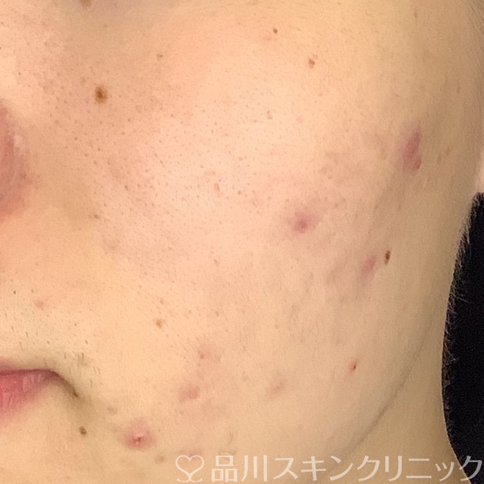 症例NO.69486のBEFORE写真