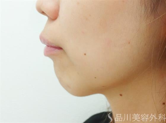 症例NO.30237のBEFORE写真