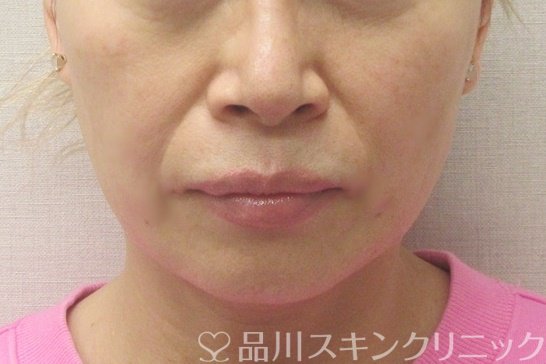 症例NO.72768のAFTER写真