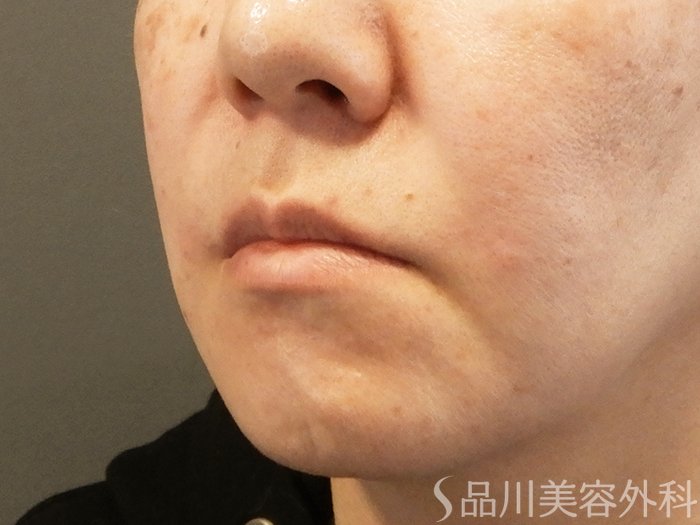 症例NO.67987のAFTER写真