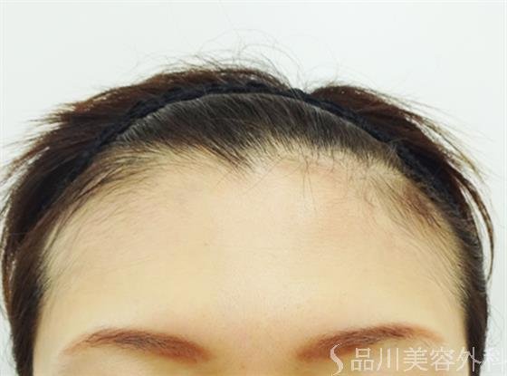 症例NO.42818のBEFORE写真