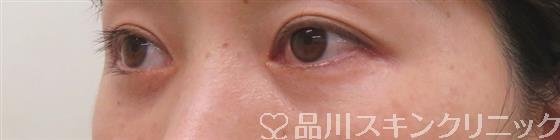 症例NO.58405のBEFORE写真