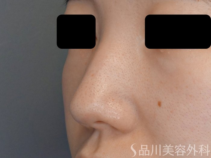 症例NO.70145のBEFORE写真