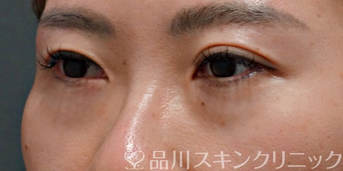 症例NO.73388のBEFORE写真