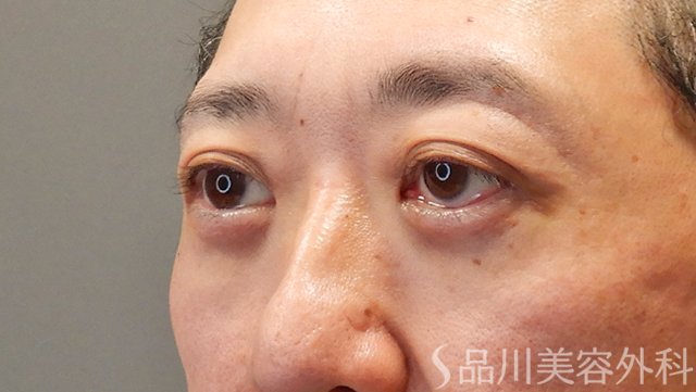 症例NO.74560のAFTER写真