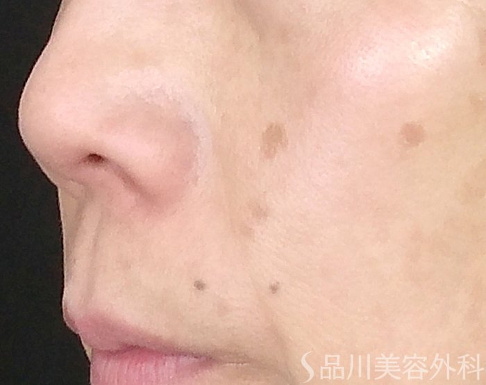 症例NO.64747のBEFORE写真