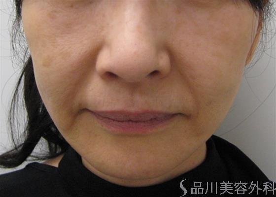 症例NO.27828のBEFORE写真