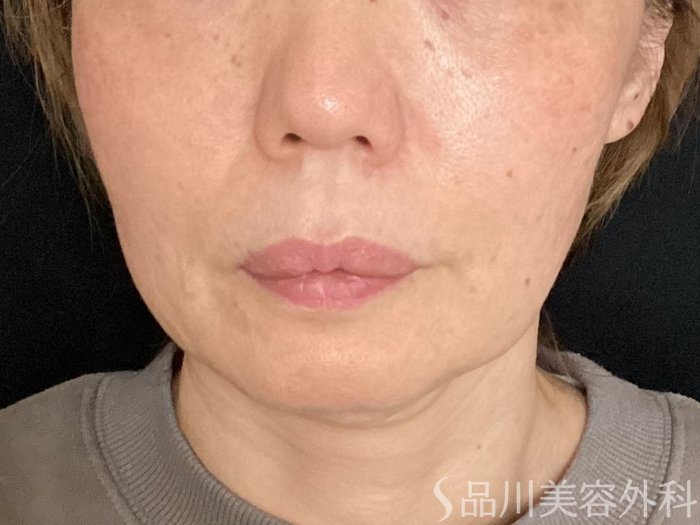 症例NO.65297のBEFORE写真
