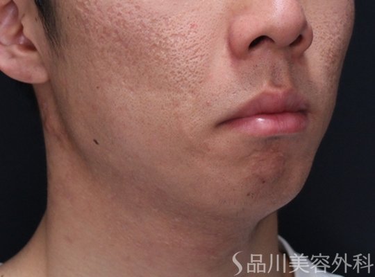 症例NO.72982のAFTER写真