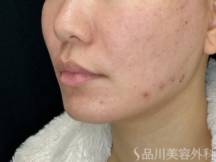 症例NO.72500のAFTER写真