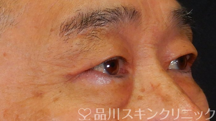 症例NO.65677のAFTER写真