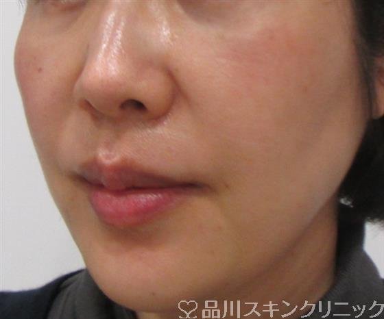 症例NO.25901のAFTER写真