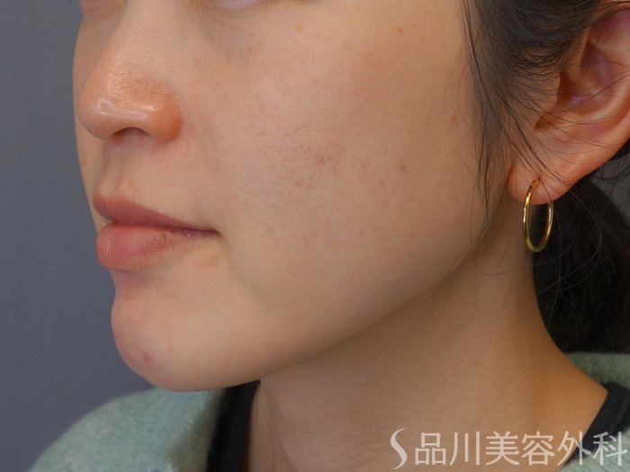 症例NO.74577のBEFORE写真