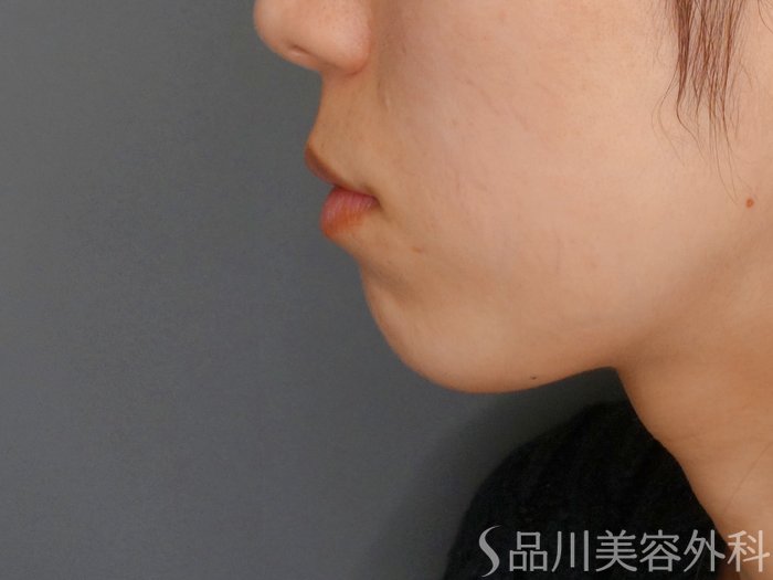 症例NO.63486のBEFORE写真