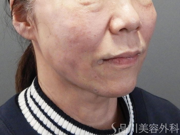 症例NO.74247のAFTER写真