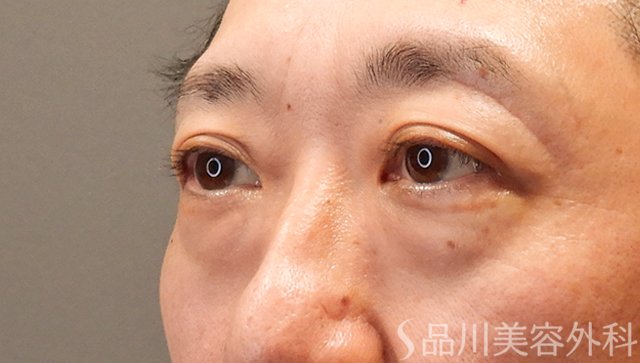 症例NO.75058のBEFORE写真