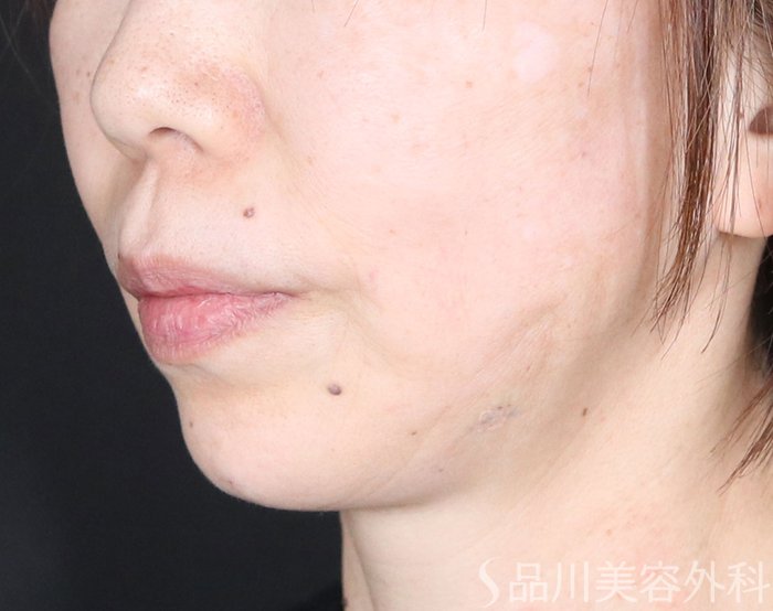 症例NO.73410のAFTER写真