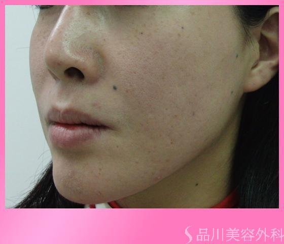 症例NO.4086のBEFORE写真
