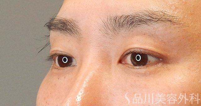 症例NO.75249のBEFORE写真