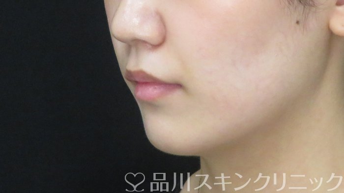 症例NO.72370のBEFORE写真