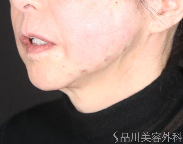 症例NO.72265のAFTER写真