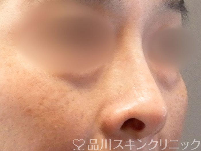 症例NO.63387のBEFORE写真