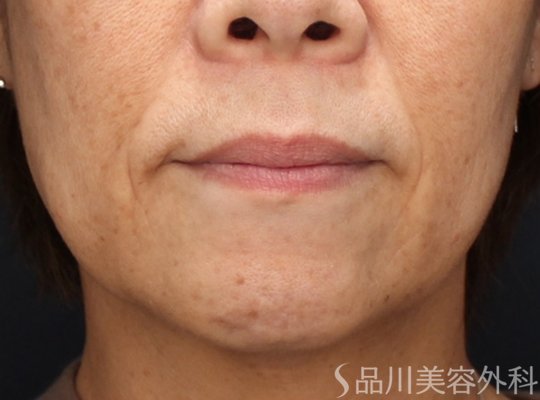 症例NO.72179のBEFORE写真