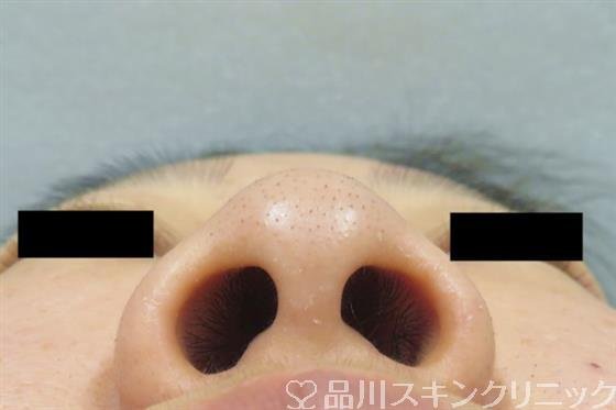 症例NO.58121のBEFORE写真
